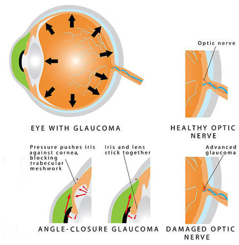 Angle Closure Glaucoma Chart
