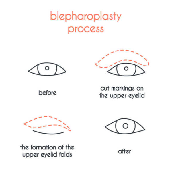 Blepharoplasty Process
