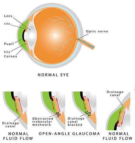 Open Angle Glaucoma Chart